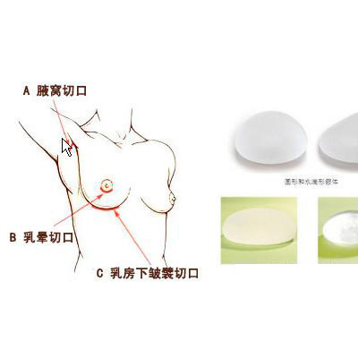 产后胸部下垂选择自体还是假体?韦元强 产后胸部下垂选择自体还是假体?韦元强