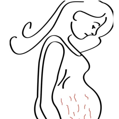 孕期有妊娠纹困扰怎么办?教你一招轻松淡化! 孕期有妊娠纹困扰怎么办?教你一招轻松淡化!